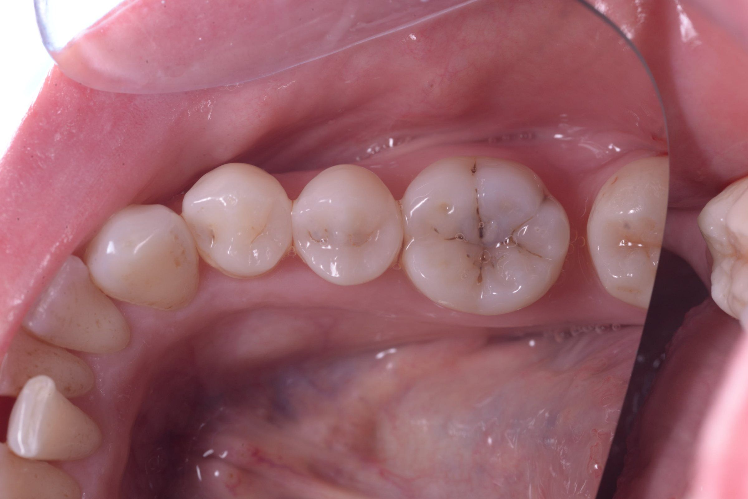 A back tooth with dark staining and decay in its fissures, before treatment